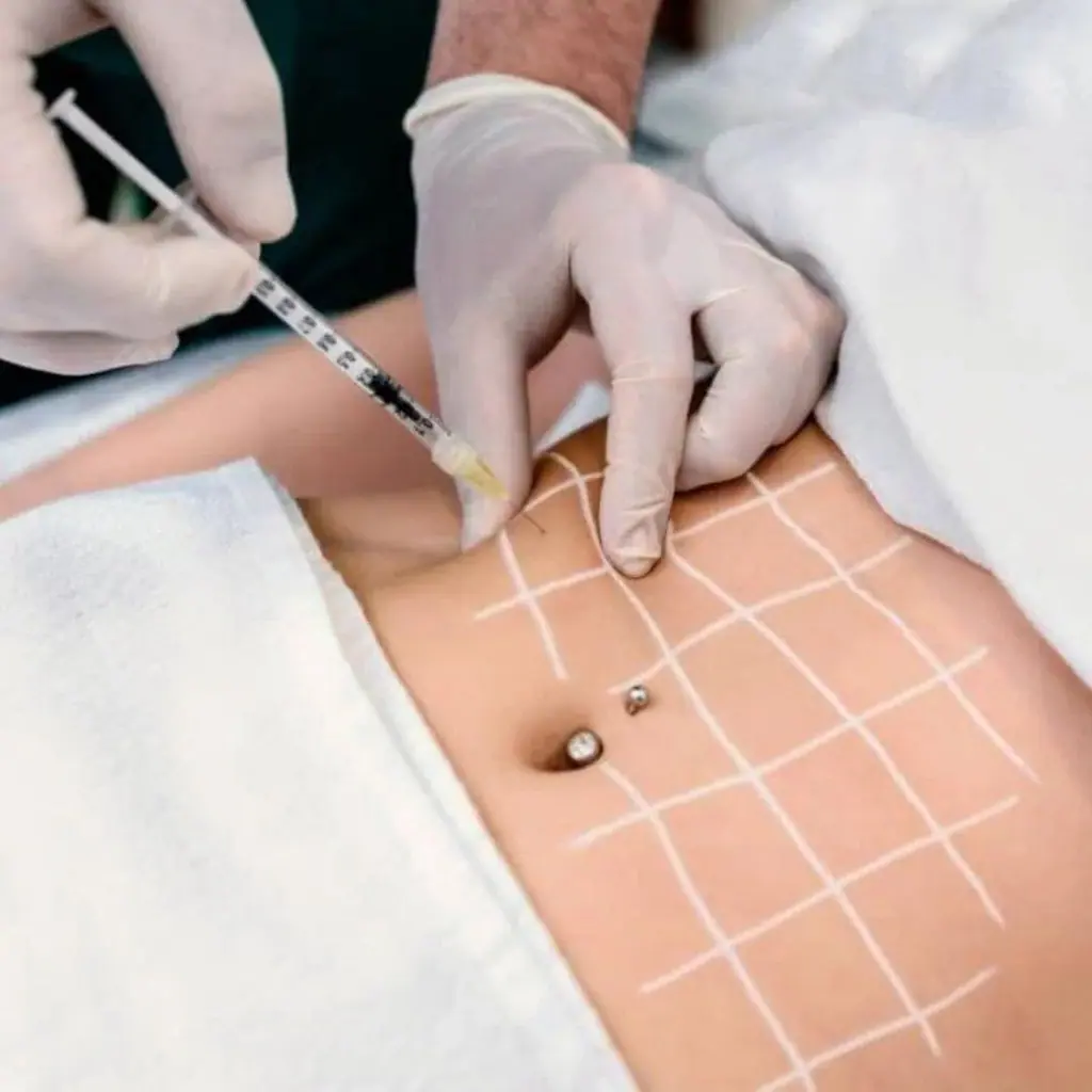 mesoterapia